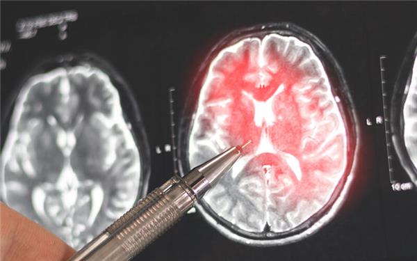 Die Neurologie der Kliniken Sindelfingen-Böblingen erhält mit Dr. Stephan Lauxmann einen neuen Chefarzt. GB-Foto (Symbolbild): Vadym – stock.adobe.com